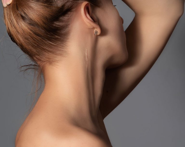 Microneedling for Scarring, Regenerative Aesthetics,Mason, Ohio, Dr Naila Goldenberg