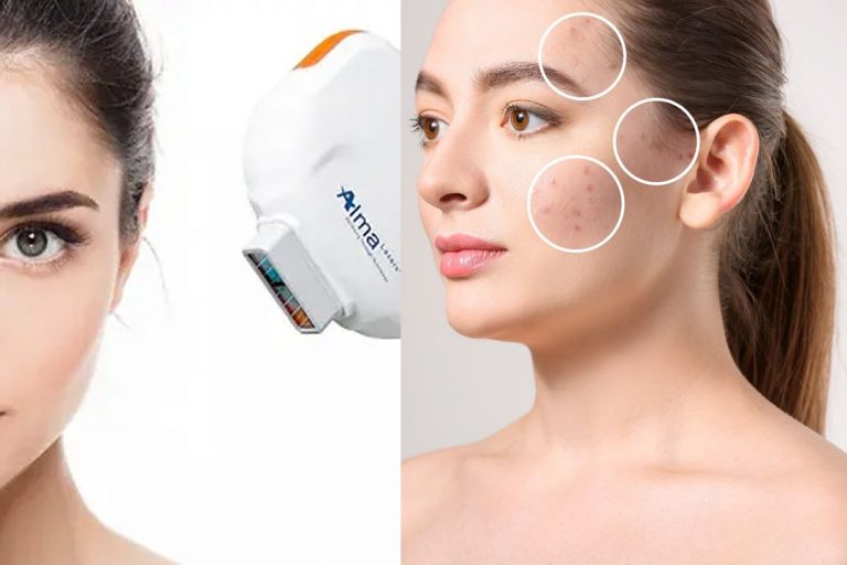 DYE VL IPL TREATMENT ALMA, Functional Aesthetics, Dr Naila Goldenberg, Mason, Ohio