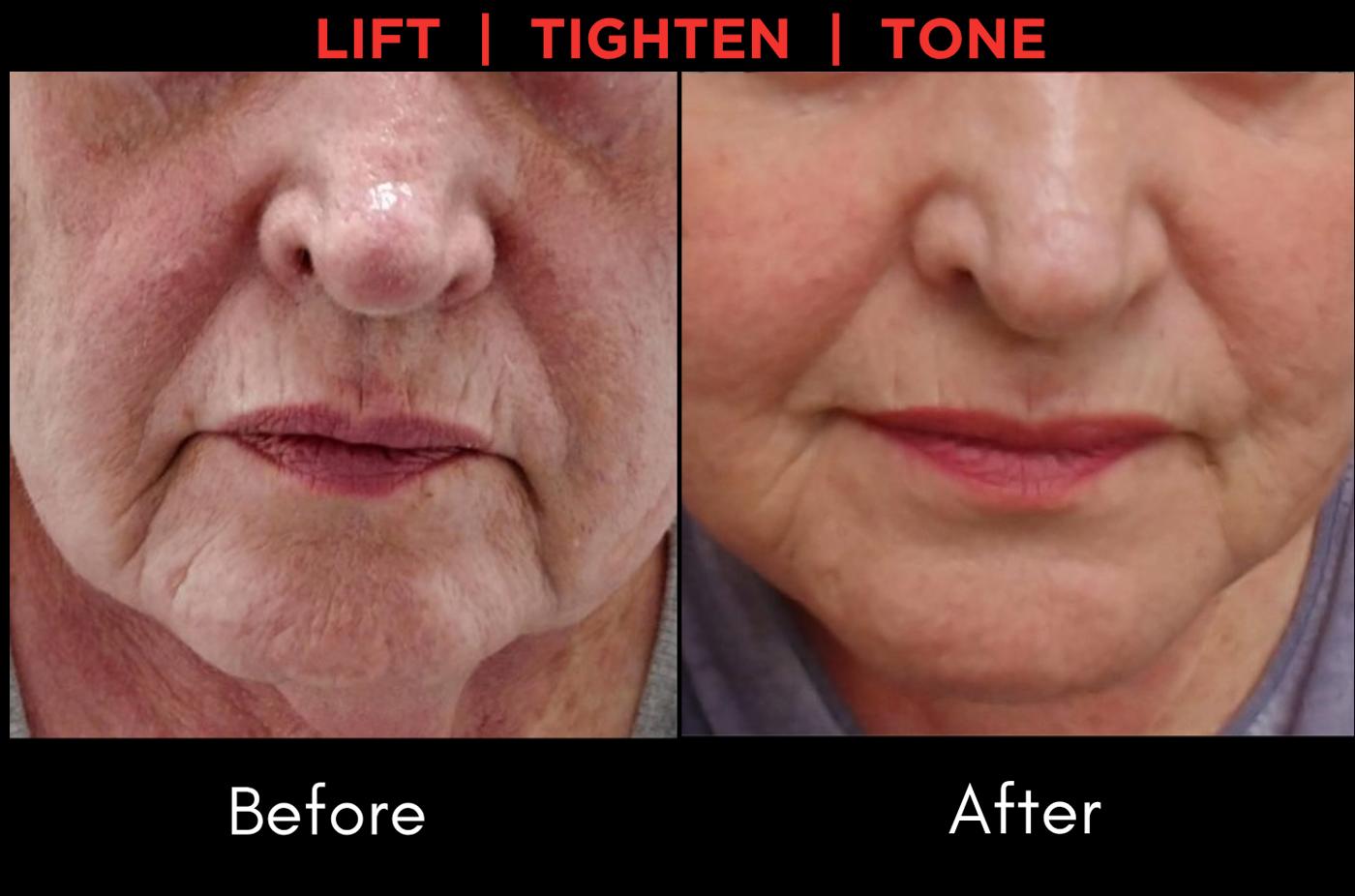 before after 2 scarlet pro Regenerative Aesthetics DR Naila Goldenberg