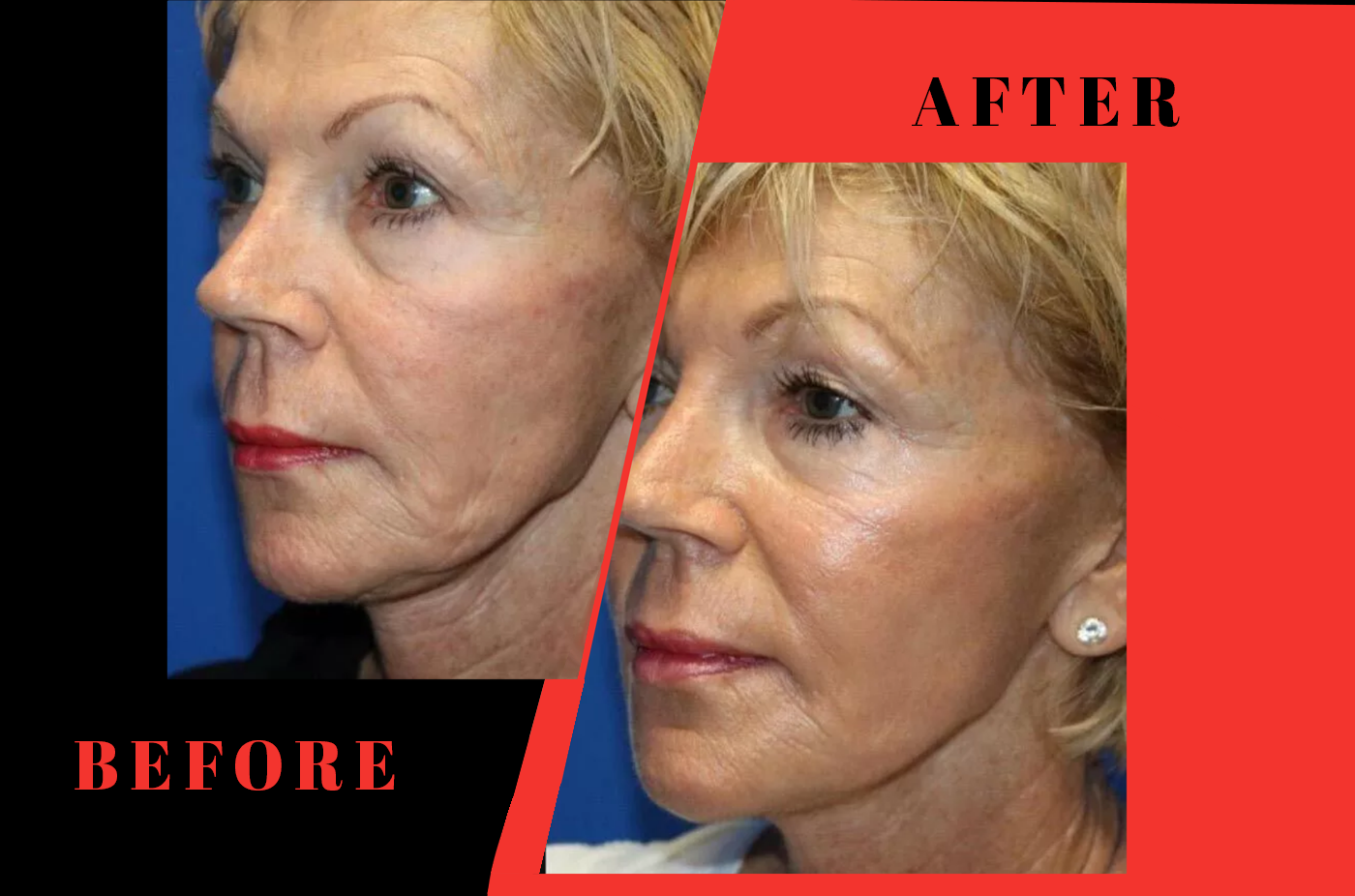 before after 3 scarlet pro Regenerative Aesthetics DR Naila Goldenberg