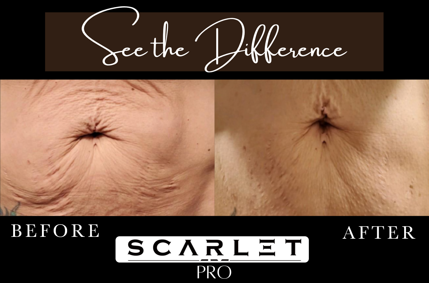 before after 5 scarlet pro Regenerative Aesthetics DR Naila Goldenberg