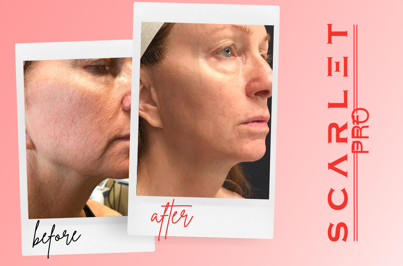 before after 6 scarlet pro Regenerative Aesthetics DR Naila Goldenberg