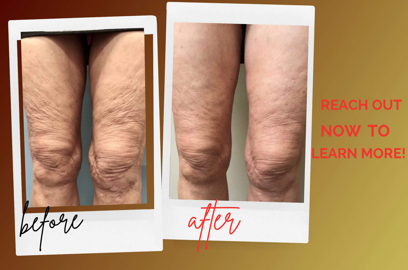 before after 8 scarlet pro Regenerative Aesthetics DR Naila Goldenberg