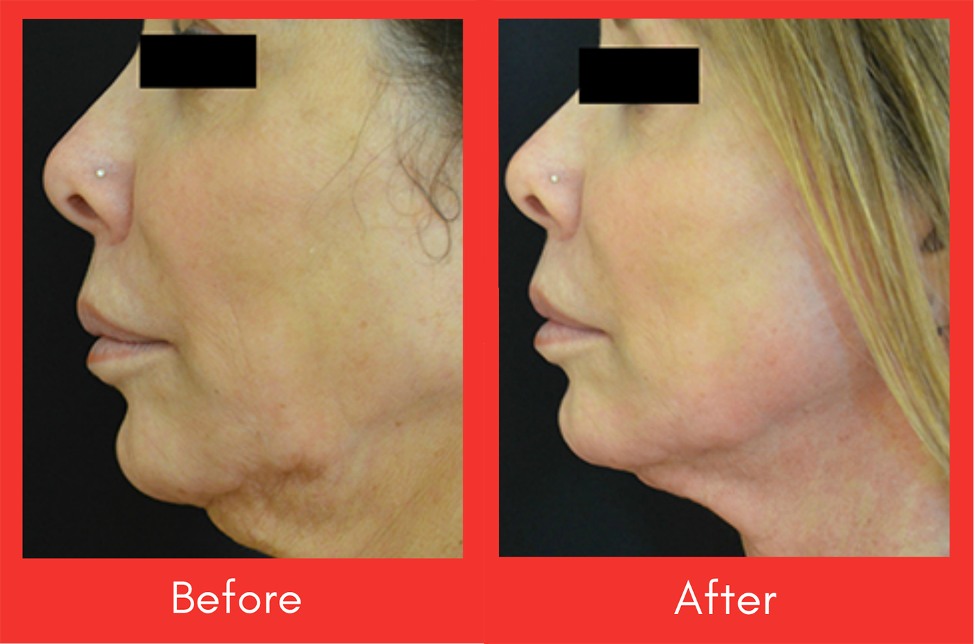 before after scarlet pro Regenerative Aesthetics DR Naila Goldenberg
