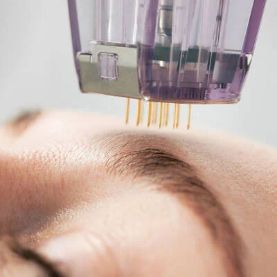 Scarlet Pro Microneedling in Mason, Ohio, Regenerative Aesthetics
