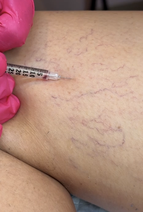 Asclera® Injections for Spider Veins, Mason, Ohio, Regenerative Aesthetics