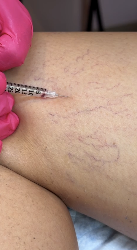 Asclera® Injections for Spider Veins, Mason, Ohio, Regenerative Aesthetics