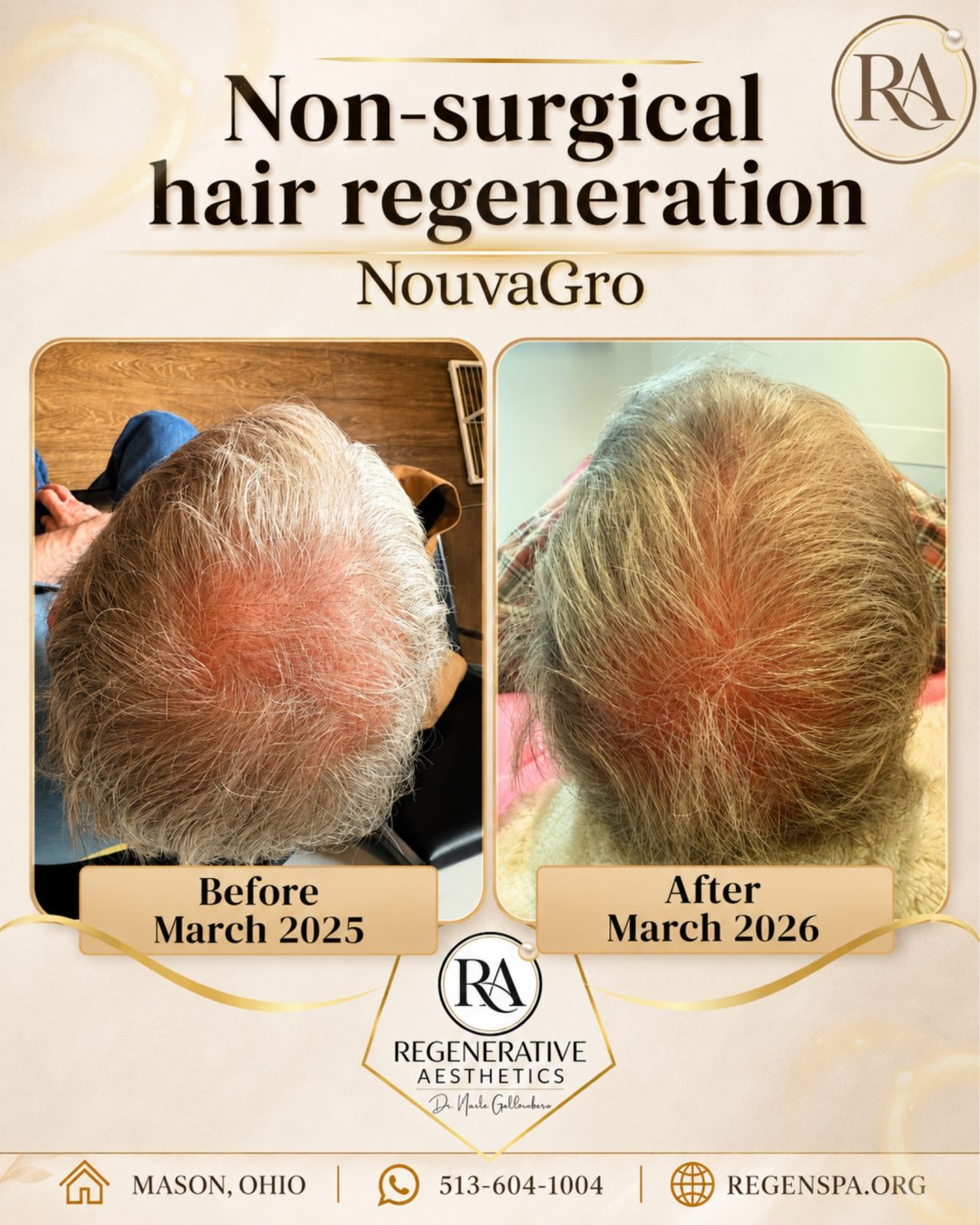 Nouvagro hair treatment Hair Regenerative, Regenerative Aesthetics Mason Ohio